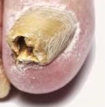 thick hollow nail